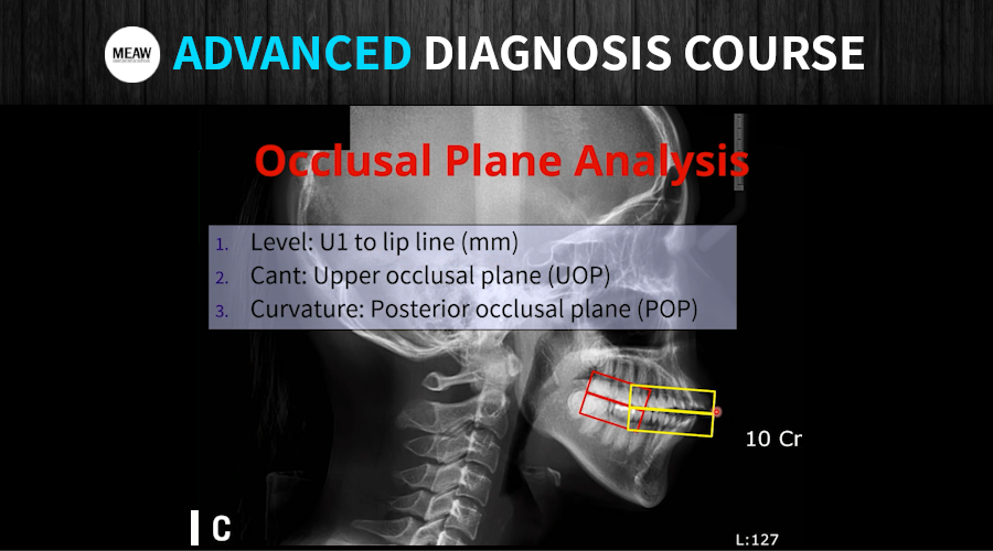3. OCCLUSAL PLANE ANALYSIS