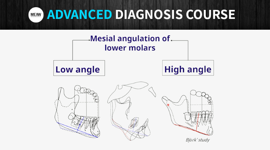 4. Factors Affecting Occlusal Plane